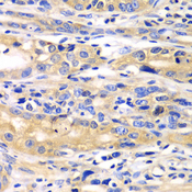 SARS / Serine-tRNA Ligase Antibody - Immunohistochemistry of paraffin-embedded human gastric cancer tissue.