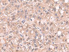 SARS / Serine-tRNA Ligase Antibody - Immunohistochemistry of paraffin-embedded Human liver cancer tissue  using SARS Polyclonal Antibody at dilution of 1:65(×200)