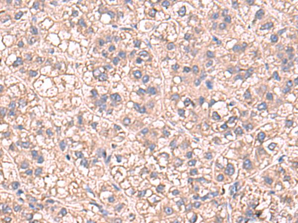 SARS / Serine-tRNA Ligase Antibody - Immunohistochemistry of paraffin-embedded Human liver cancer tissue  using SARS Polyclonal Antibody at dilution of 1:60(×200)