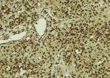 SART1 Antibody - 1:100 staining human breast carcinoma tissue by IHC-P. The sample was formaldehyde fixed and a heat mediated antigen retrieval step in citrate buffer was performed. The sample was then blocked and incubated with the antibody for 1.5 hours at 22°C. An HRP conjugated goat anti-rabbit antibody was used as the secondary.