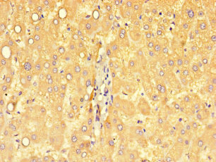 SART2 / DSE Antibody - Immunohistochemistry of paraffin-embedded human liver cancer using DSE Antibody at dilution of 1:100