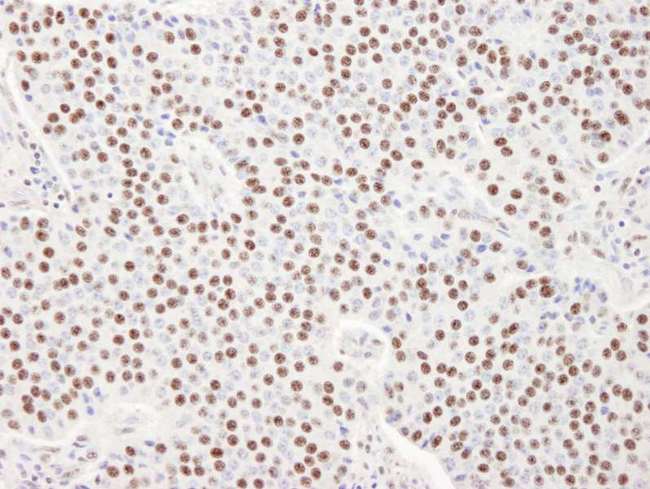 SART3 Antibody - Detection of Human SART3/TIP110 by Immunohistochemistry. Sample: FFPE section of human pancreatic islet cell tumor. Antibody: Affinity purified rabbit anti-SART3/TIP110 used at a dilution of 1:100.