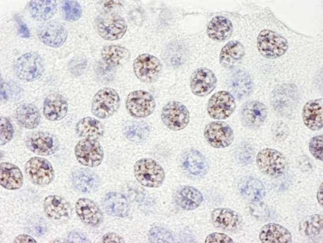SART3 Antibody - Detection of Human SART3/TIP110 by Immunohistochemistry. Sample: FFPE section of human pancreatic islet cell tumor. Antibody: Affinity purified rabbit anti-SART3/TIP110 used at a dilution of 1:250.