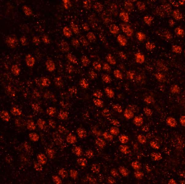 SART3 Antibody - Detection of human SART3/TIP110 by immunohistochemistry. Sample: FFPE section of human pancreatic islet cell tumor. Antibody: Affinity purified rabbit anti-SART3/TIP110 used at a dilution of 1:100. Detection: Red-fluorescent goat anti-rabbit IgG highly cross-adsorbed Antibody used at a dilution of 1:100.