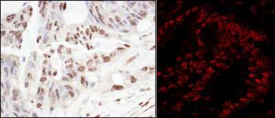 SART3 Antibody - Detection of Human SART3/TIP110 by Immunohistochemistry and Immunofluorescence. Sample: FFPE sections of human ovarian carcinoma (left) and colon carcinoma (right). Antibody: Affinity purified rabbit anti-SART3/TIP110 used at a dilution of 1:200 (1 ug/ml) and 1:400 (0.5 ug/ml). Detection: DAB and Red-fluorescent Goat anti-Rabbit IgG-heavy and light chain, cross-adsorbed Antibody DyLight 594 Conjugated used at a dilution of 1:100.