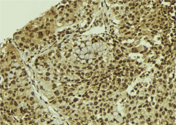 SART3 Antibody - 1:100 staining human breast carcinoma tissue by IHC-P. The sample was formaldehyde fixed and a heat mediated antigen retrieval step in citrate buffer was performed. The sample was then blocked and incubated with the antibody for 1.5 hours at 22°C. An HRP conjugated goat anti-rabbit antibody was used as the secondary.