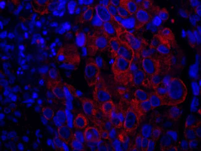 SASH1 Antibody - Detection of Human SASH1 by Immunohistochemistry. Sample: FFPE section of human breast carcinoma. Antibody: Affinity purified rabbit anti-SASH1 used at a dilution of 1:100. Detection: Red-fluorescent Goat anti-Rabbit IgG-heavy and light chain cross-adsorbed Antibody DyLight 594 Conjugated (A120-601D4) used at a dilution of 1:100.