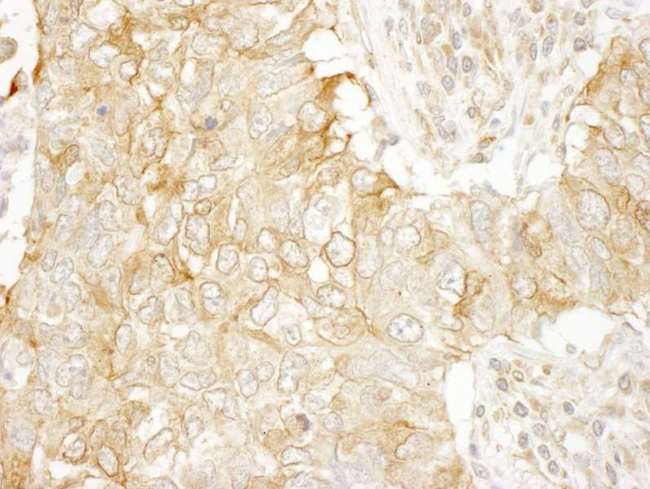 SASH1 Antibody - Detection of Human SASH1 by Immunohistochemistry. Sample: FFPE section of human lung carcinoma. Antibody: Affinity purified rabbit anti-SASH1 used at a dilution of 1:250.