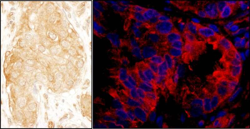 SASH1 Antibody - Detection of Human SASH1 by Immunohistochemistry and Immunofluorescence. Sample: FFPE sections of human breast carcinoma (left) and lung carcinoma (right). Antibody: Affinity purified rabbit anti-SASH1 used at a dilution of 1:1000 (1 ug/ml) and 1:400 (2.5 ug/ml). Detection: DAB and Red-fluorescent Goat anti-Rabbit IgG-heavy and light chain, cross-adsorbed Antibody DyLight 594 Conjugated used at a dilution of 1:100.
