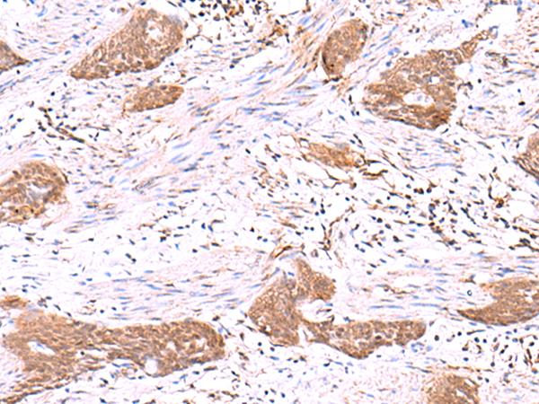 SASH1 Antibody - Immunohistochemistry of paraffin-embedded Human esophagus cancer tissue  using SASH1 Polyclonal Antibody at dilution of 1:30(×200)
