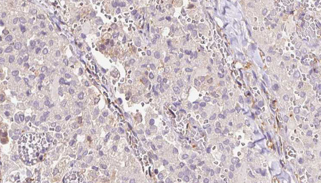 SAT1 / SAT Antibody - 1:100 staining human thyroid carcinoma tissue by IHC-P. The sample was formaldehyde fixed and a heat mediated antigen retrieval step in citrate buffer was performed. The sample was then blocked and incubated with the antibody for 1.5 hours at 22°C. An HRP conjugated goat anti-rabbit antibody was used as the secondary.