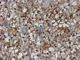 SAT2 Antibody - IHC of paraffin-embedded Carcinoma of Human kidney tissue using anti-SAT2 mouse monoclonal antibody.