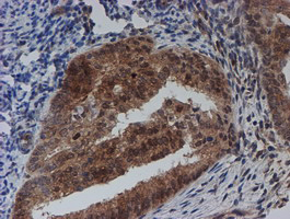 SAT2 Antibody - IHC of paraffin-embedded Adenocarcinoma of Human endometrium tissue using anti-SAT2 mouse monoclonal antibody.
