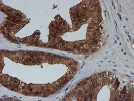 SAT2 Antibody - IHC of paraffin-embedded Carcinoma of Human prostate tissue using anti-SAT2 mouse monoclonal antibody.