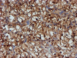 SAT2 Antibody - IHC of paraffin-embedded Carcinoma of Human kidney tissue using anti-SAT2 mouse monoclonal antibody. (Heat-induced epitope retrieval by 10mM citric buffer, pH6.0, 100C for 10min).