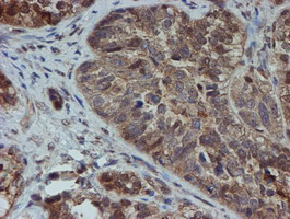 SAT2 Antibody - IHC of paraffin-embedded Adenocarcinoma of Human ovary tissue using anti-SAT2 mouse monoclonal antibody. (Heat-induced epitope retrieval by 10mM citric buffer, pH6.0, 100C for 10min).