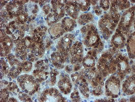 SAT2 Antibody - IHC of paraffin-embedded Carcinoma of Human thyroid tissue using anti-SAT2 mouse monoclonal antibody. (Heat-induced epitope retrieval by 10mM citric buffer, pH6.0, 100C for 10min).