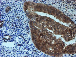 SAT2 Antibody - IHC of paraffin-embedded Adenocarcinoma of Human endometrium tissue using anti-SAT2 mouse monoclonal antibody. (Heat-induced epitope retrieval by 10mM citric buffer, pH6.0, 100C for 10min).