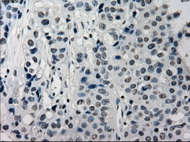 SATB1 Antibody - IHC of paraffin-embedded Adenocarcinoma of breast tissue using anti-SATB1 mouse monoclonal antibody. (Dilution 1:50).