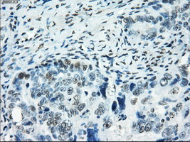SATB1 Antibody - IHC of paraffin-embedded Adenocarcinoma of ovary tissue using anti-SATB1 mouse monoclonal antibody. (Dilution 1:50).