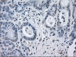 SATB1 Antibody - IHC of paraffin-embedded Adenocarcinoma of colon tissue using anti-SATB1 mouse monoclonal antibody. (Dilution 1:50).