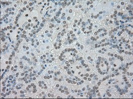 SATB1 Antibody - Immunohistochemical staining of paraffin-embedded Carcinoma of kidney tissue using anti-SATB1 mouse monoclonal antibody. (Dilution 1:50).