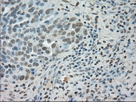 SATB1 Antibody - Immunohistochemical staining of paraffin-embedded Adenocarcinoma of ovary tissue using anti-SATB1 mouse monoclonal antibody. (Dilution 1:50).