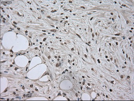 SATB1 Antibody - Immunohistochemical staining of paraffin-embedded Carcinoma of pancreas tissue using anti-SATB1 mouse monoclonal antibody. (Dilution 1:50).