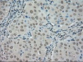 SATB1 Antibody - Immunohistochemical staining of paraffin-embedded Adenocarcinoma of breast tissue using anti-SATB1 mouse monoclonal antibody. (Dilution 1:50).