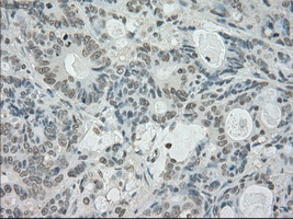SATB1 Antibody - Immunohistochemical staining of paraffin-embedded Adenocarcinoma of colon tissue using anti-SATB1 mouse monoclonal antibody. (Dilution 1:50).