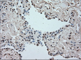 SATB1 Antibody - Immunohistochemical staining of paraffin-embedded Carcinoma of lung tissue using anti-SATB1 mouse monoclonal antibody. (Dilution 1:50).