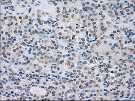 SATB1 Antibody - Immunohistochemical staining of paraffin-embedded Carcinoma of thyroid tissue using anti-SATB1 mouse monoclonal antibody. (Dilution 1:50).