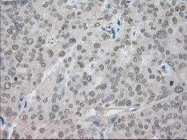 SATB1 Antibody - Immunohistochemical staining of paraffin-embedded Adenocarcinoma of endometrium tissue using anti-SATB1 mouse monoclonal antibody. (Dilution 1:50).