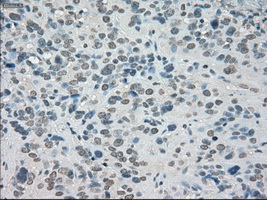 SATB1 Antibody - Immunohistochemical staining of paraffin-embedded Carcinoma of bladder tissue using anti-SATB1 mouse monoclonal antibody. (Dilution 1:50).