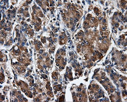 SATB1 Antibody - IHC of paraffin-embedded Carcinoma of liver tissue using anti-SATB1 mouse monoclonal antibody. (Dilution 1:50).