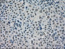 SATB1 Antibody - Immunohistochemical staining of paraffin-embedded Adenocarcinoma of breast tissue using anti-SATB1 mouse monoclonal antibody. (Dilution 1:50).
