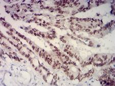 SATB2 Antibody - Immunohistochemical analysis of paraffin-embedded colon cancer tissues using SATB2 mouse mAb with DAB staining.