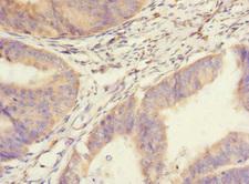 SAV1 / WW45 Antibody - Immunohistochemistry of paraffin-embedded human endometrial cancer at dilution 1:100