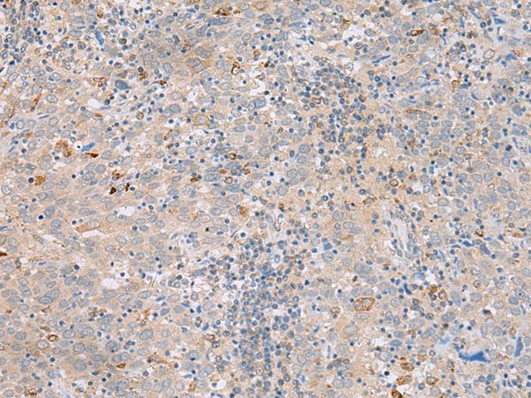 SAXO2 / FAM154B Antibody - Immunohistochemistry of paraffin-embedded Human cervical cancer tissue  using SAXO2 Polyclonal Antibody at dilution of 1:45(×200)