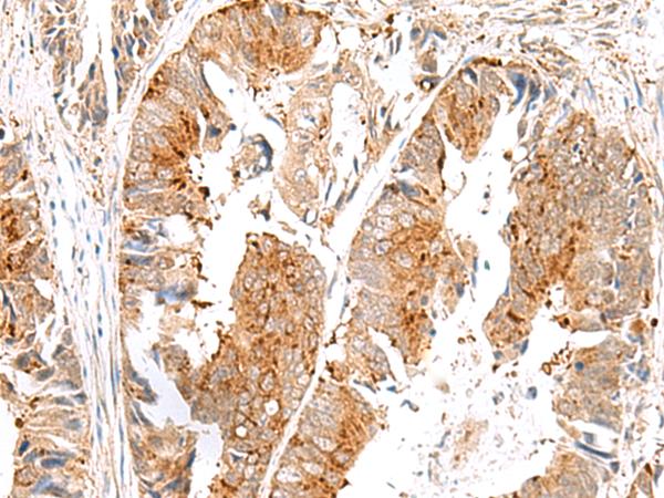 SAXO2 / FAM154B Antibody - Immunohistochemistry of paraffin-embedded Human colorectal cancer tissue  using SAXO2 Polyclonal Antibody at dilution of 1:45(×200)