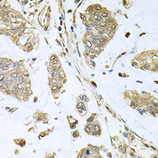 SBDS Antibody - Immunohistochemistry of paraffin-embedded human gastric cancer tissue.