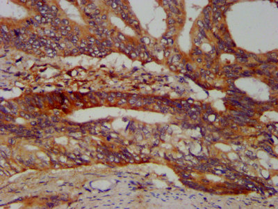 SBDS Antibody - Immunohistochemistry image at a dilution of 1:400 and staining in paraffin-embedded human colon cancer performed on a Leica BondTM system. After dewaxing and hydration, antigen retrieval was mediated by high pressure in a citrate buffer (pH 6.0) . Section was blocked with 10% normal goat serum 30min at RT. Then primary antibody (1% BSA) was incubated at 4 °C overnight. The primary is detected by a biotinylated secondary antibody and visualized using an HRP conjugated SP system.