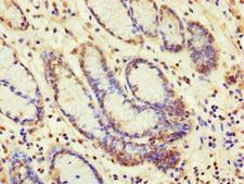 SBF2 Antibody - Immunohistochemistry of paraffin-embedded human gastric cancer at dilution of 1:100