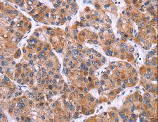SC4MOL Antibody - Immunohistochemistry of paraffin-embedded Human thyroid cancer using MSMO1 Polyclonal Antibody at dilution of 1:40.