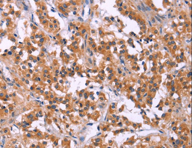 SC4MOL Antibody - Immunohistochemistry of paraffin-embedded Human thyroid cancer using MSMO1 Polyclonal Antibody at dilution of 1:40.