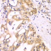 SCAD / ACADS Antibody - Immunohistochemistry of paraffin-embedded human liver cancer using ACADS antibodyat dilution of 1:100 (40x lens).