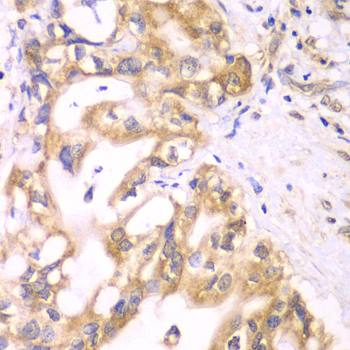 SCAD / ACADS Antibody - Immunohistochemistry of paraffin-embedded human liver cancer tissue.