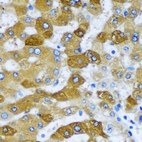 SCAD / ACADS Antibody - Immunohistochemical analysis of ACADS staining in human liver cancer formalin fixed paraffin embedded tissue section. The section was pre-treated using heat mediated antigen retrieval with sodium citrate buffer (pH 6.0). The section was then incubated with the antibody at room temperature and detected using an HRP conjugated compact polymer system. DAB was used as the chromogen. The section was then counterstained with hematoxylin and mounted with DPX.