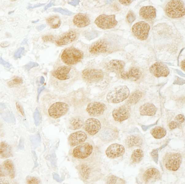 SCAF11 / SFRS2IP Antibody - Detection of Human SFRS2IP Immunohistochemistry. Sample: FFPE section of human seminoma. Antibody: Affinity purified rabbit anti-SFRS2IP used at a dilution of 1:100.