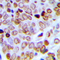 SCAF4 Antibody - Immunohistochemical analysis of SFRS15 staining in human prostate cancer formalin fixed paraffin embedded tissue section. The section was pre-treated using heat mediated antigen retrieval with sodium citrate buffer (pH 6.0). The section was then incubated with the antibody at room temperature and detected with HRP and DAB as chromogen. The section was then counterstained with hematoxylin and mounted with DPX.